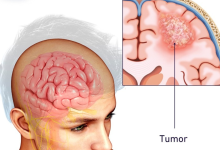 Brain tumor
