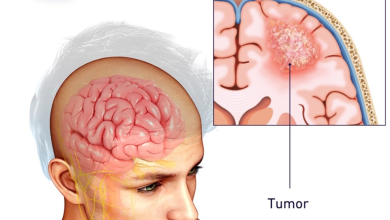 Brain tumor