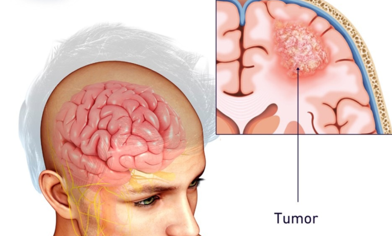 Brain tumor