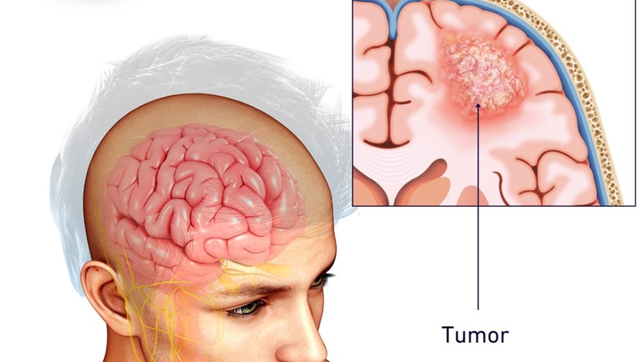 Brain tumor