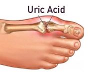 Uric acid