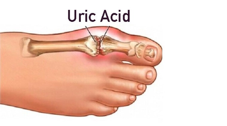 Uric acid