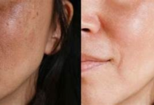 Melasma