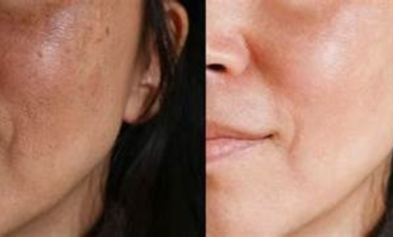 Melasma
