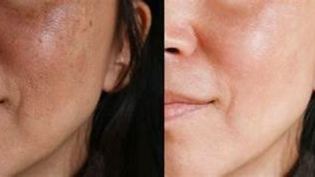 Melasma