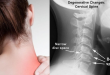 Neck Pain