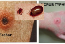 Scrub Typhus