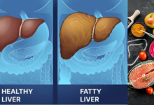 Fatty Liver