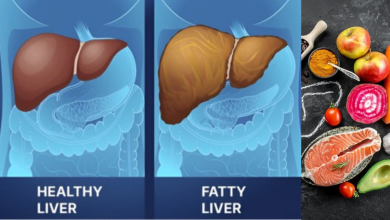 Fatty Liver