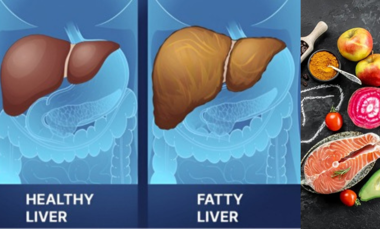 Fatty Liver