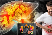 Fatty Liver