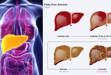 Fatty Liver
