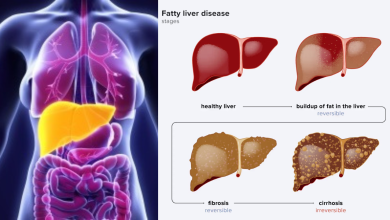 Fatty Liver