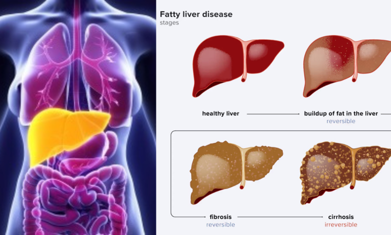 Fatty Liver
