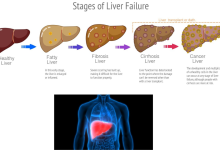 Fatty Liver