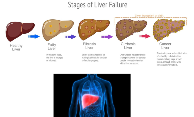 Fatty Liver