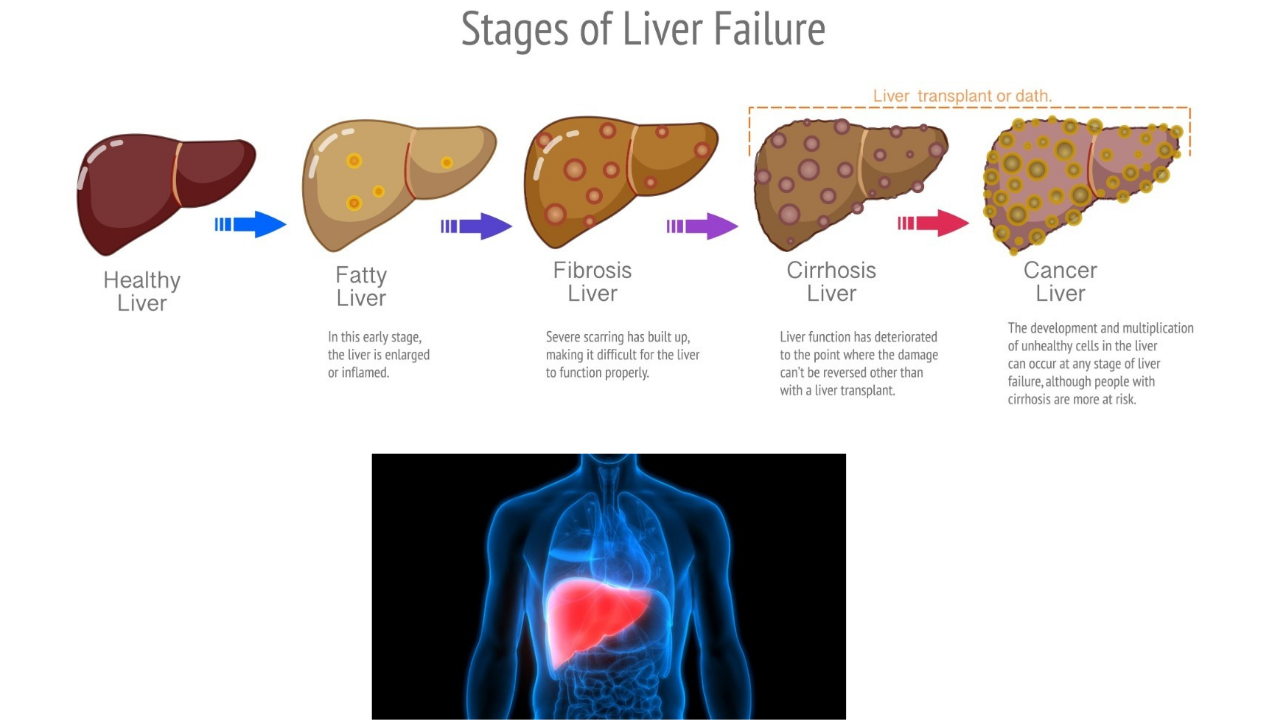Fatty Liver