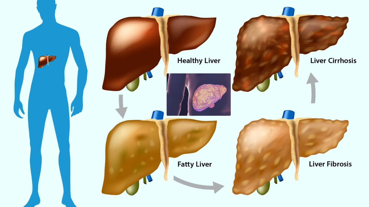 Liver Cirrhosis