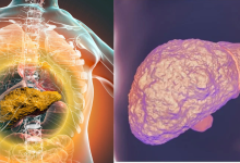 Liver Cirrhosis