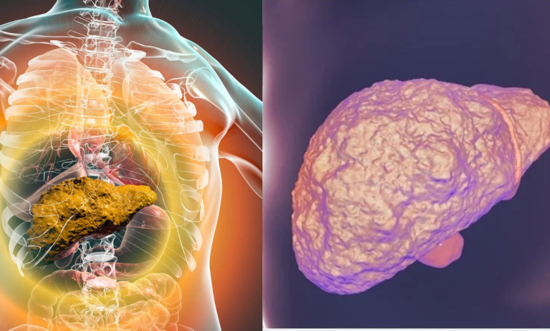 Liver Cirrhosis
