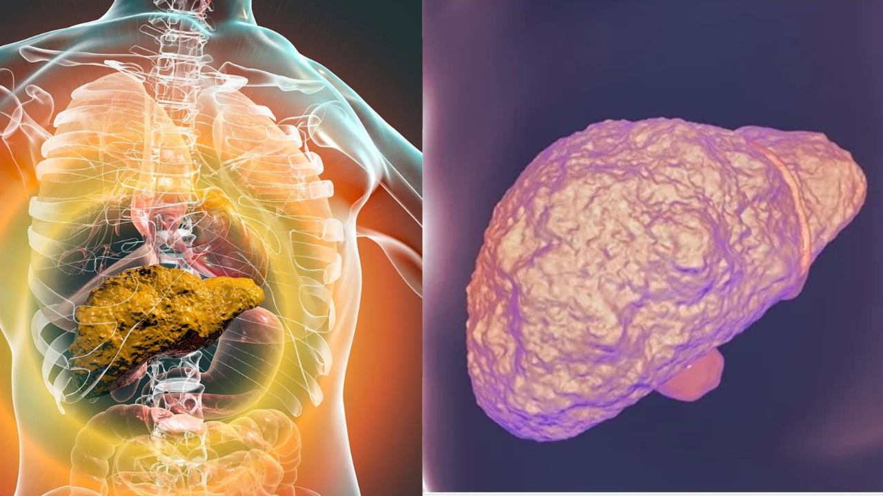 Liver Cirrhosis