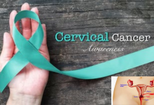 Cervical Cancer
