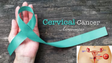 Cervical Cancer