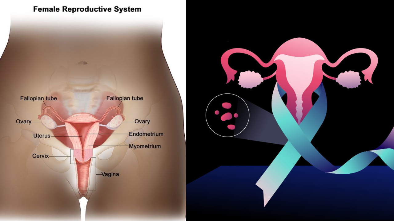 Cervical Cancer