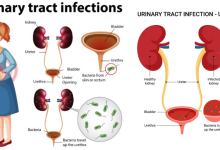 Urinary Tract Infection