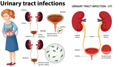 Urinary Tract Infection