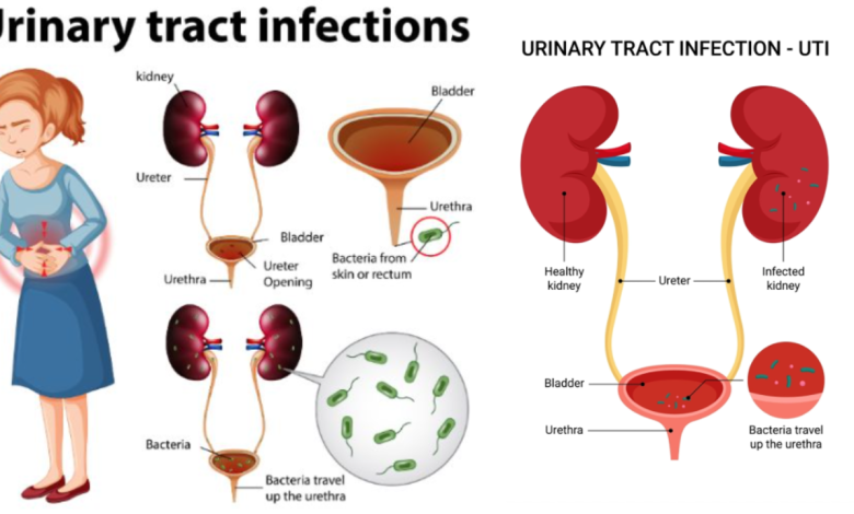 Urinary Tract Infection