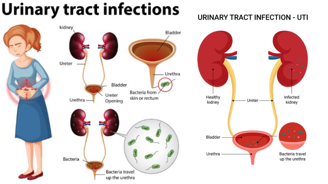 Urinary Tract Infection