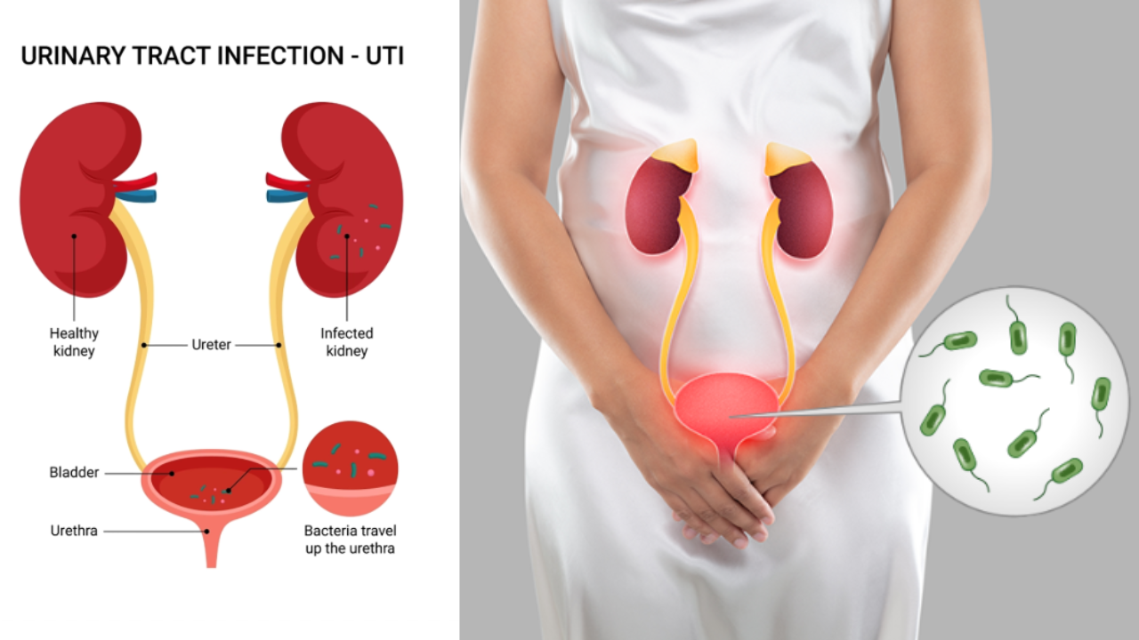 Urinary Tract Infection