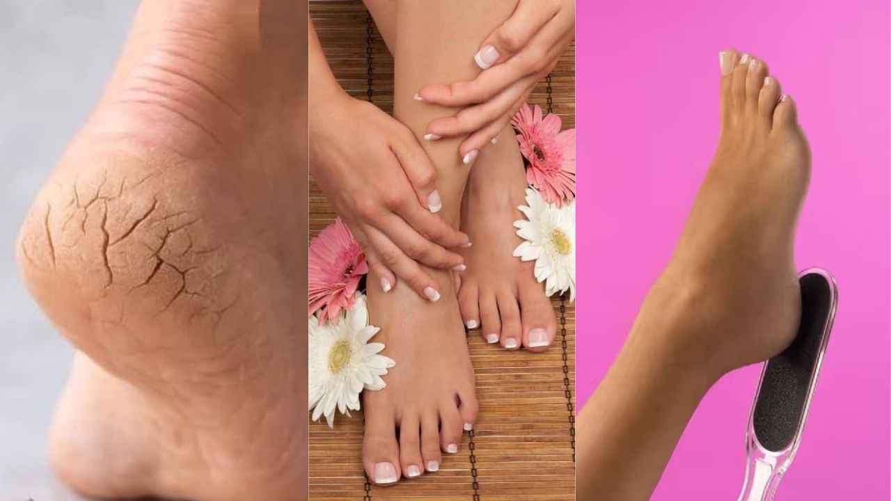 Cracked Heels