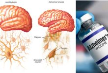 Alzheimer
