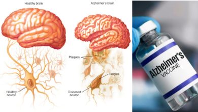 Alzheimer