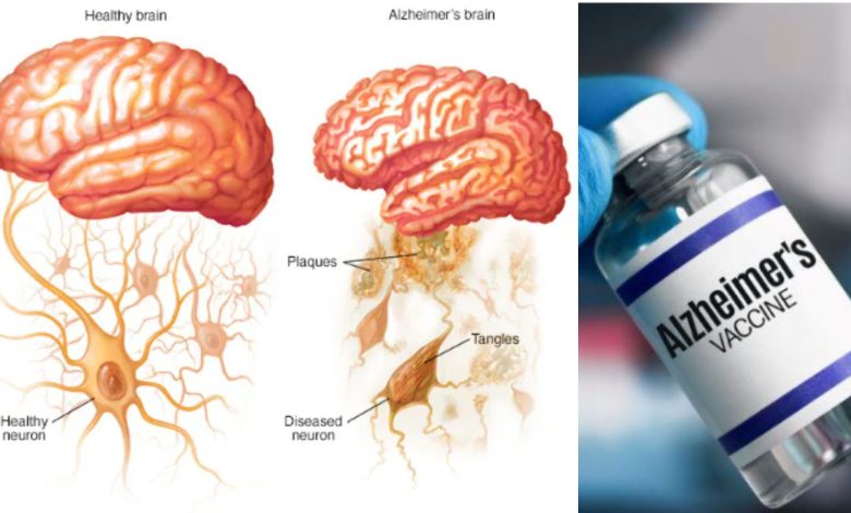 Alzheimer