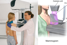 Mammogram