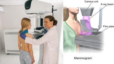 Mammogram