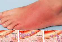 Cellulitis