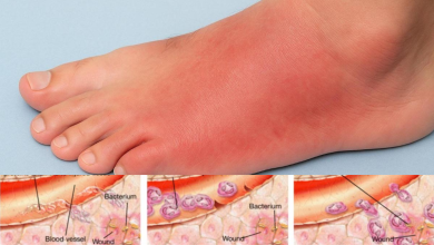 Cellulitis