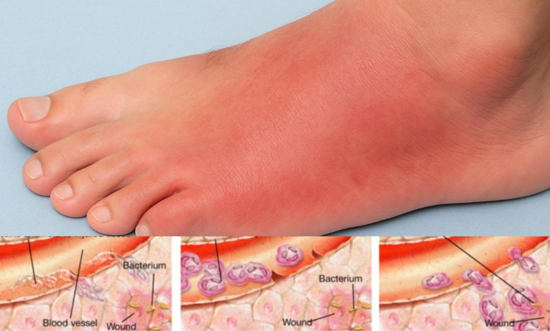 Cellulitis