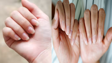 Nail Changes