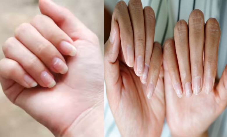 Nail Changes