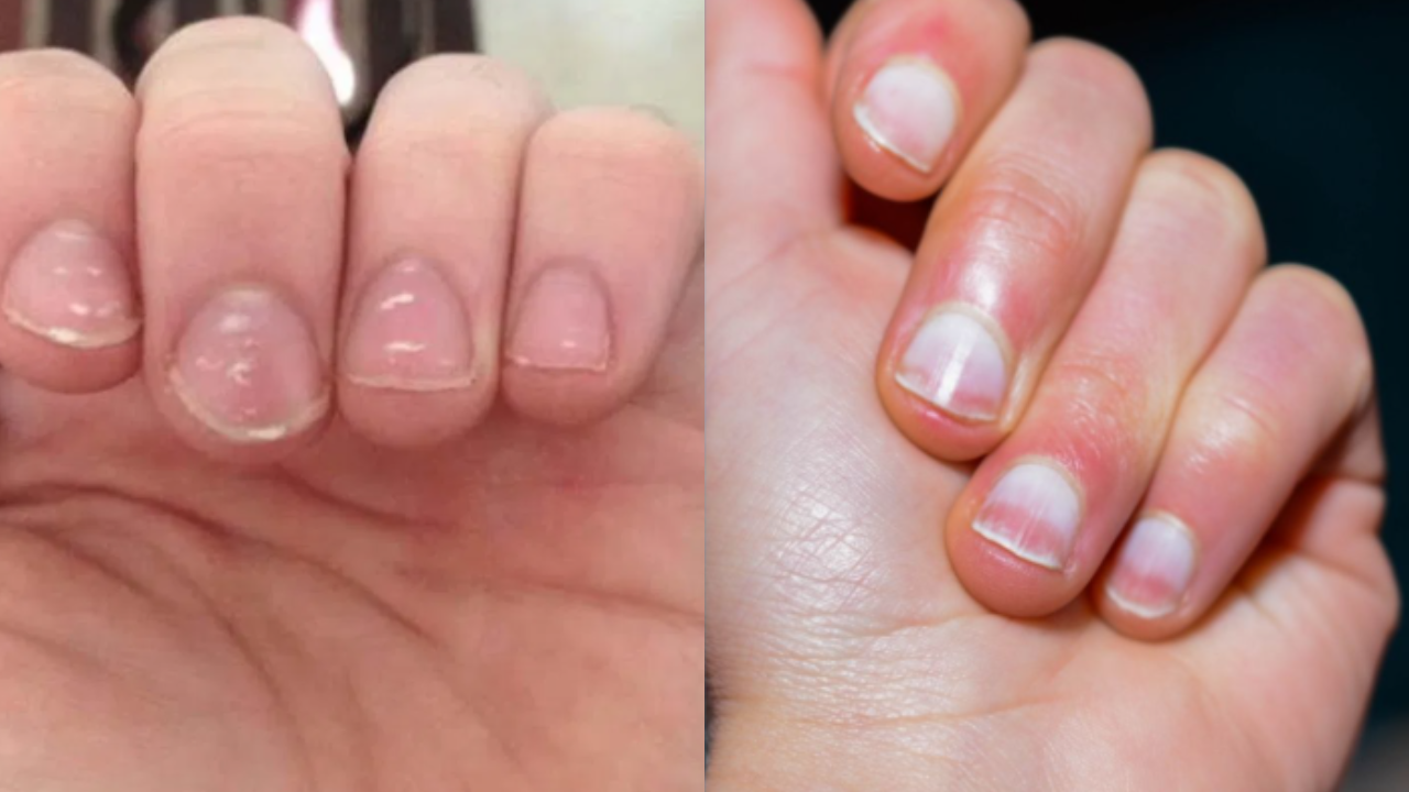 Nail Changes
