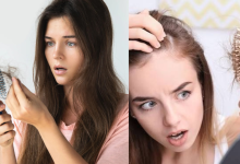 Hair Loss