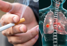 Quit Smoking